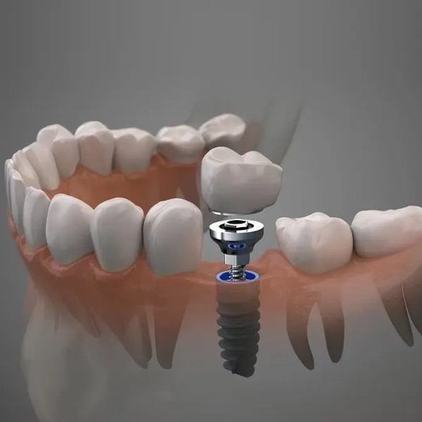 Dental Implantation