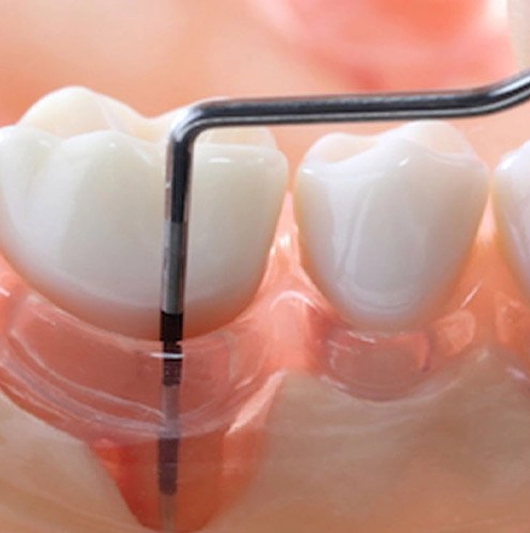 Gum Treatment or Periodontal Treatment