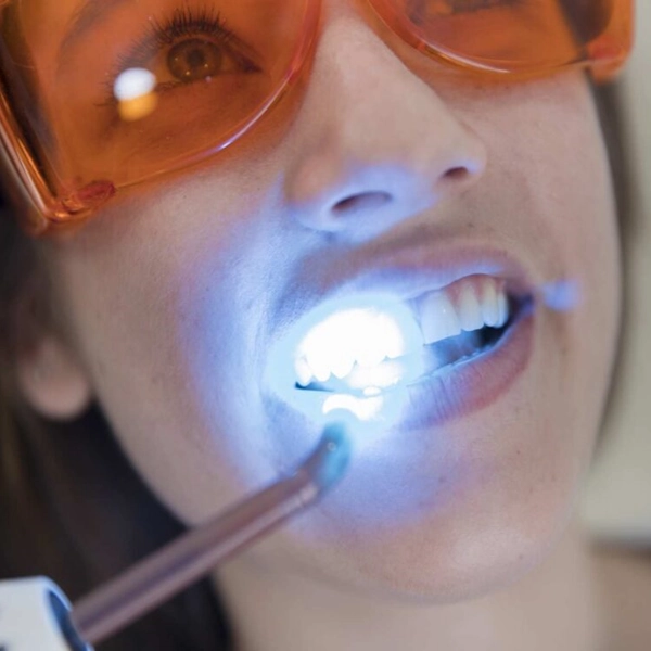 (LED) Lazer Teeth Whitening