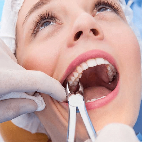 Tooth Extraction