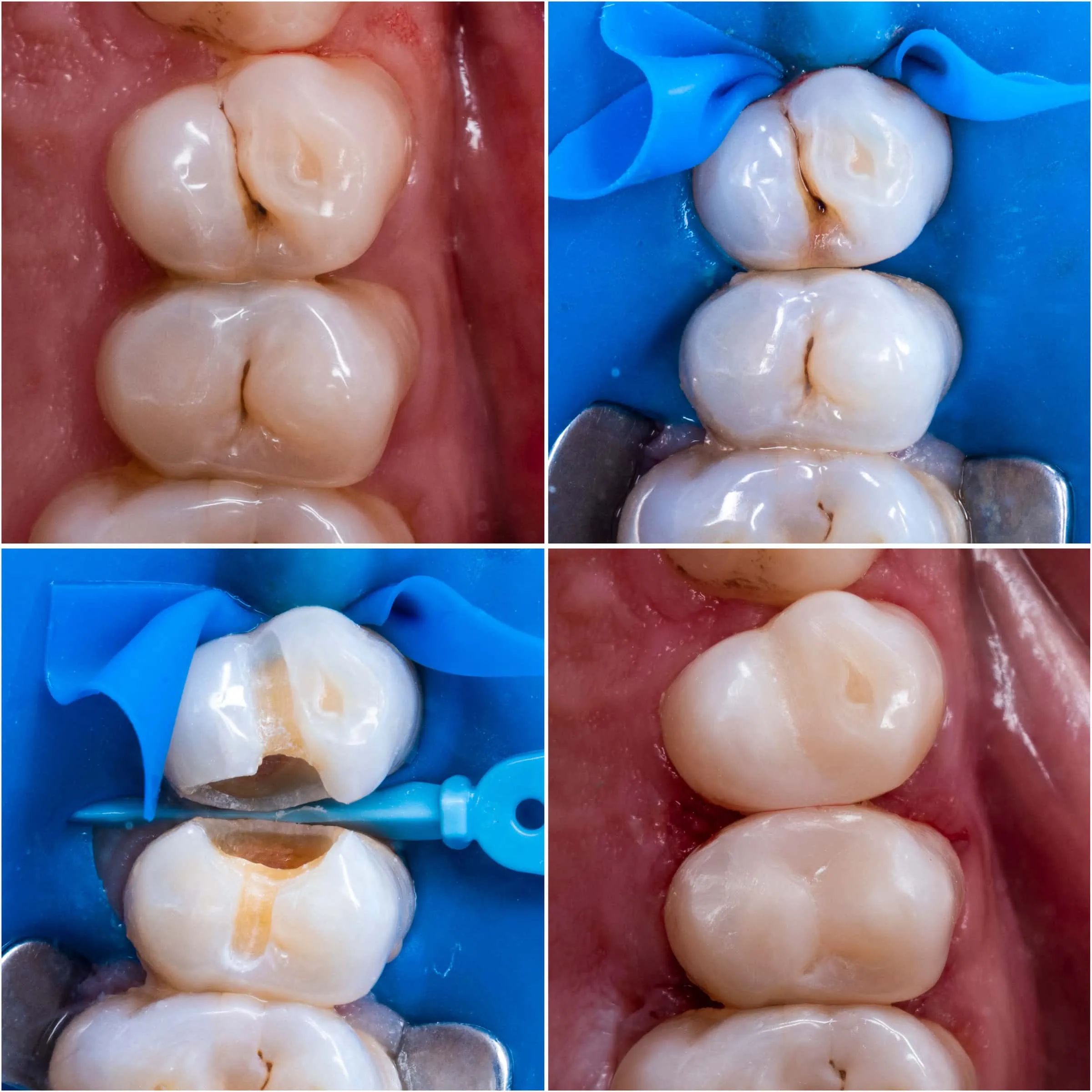 Tooth Filling